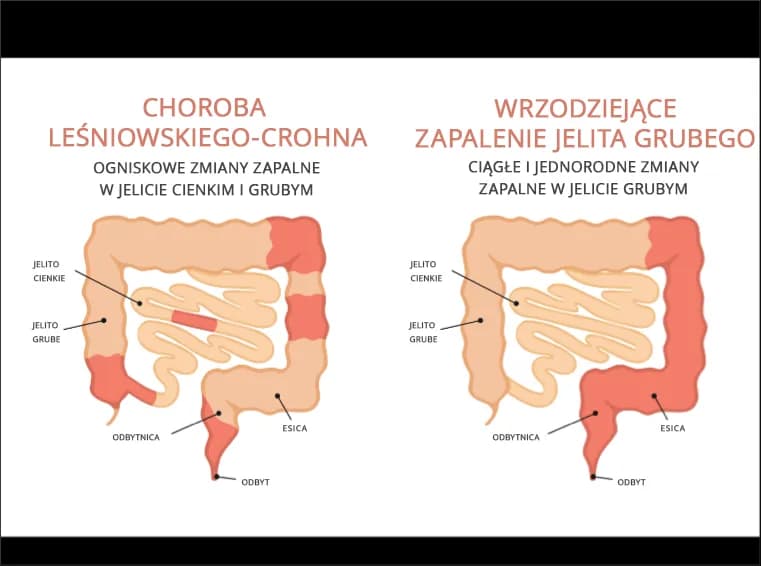 Zapalenie jelita grubego objawy - poznaj niebezpieczne sygnały zdrowotne
