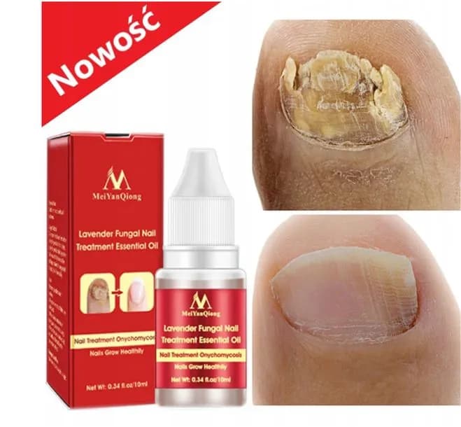 Skuteczne leki na grzybicę paznokci u nóg - uniknij bólu i problemów